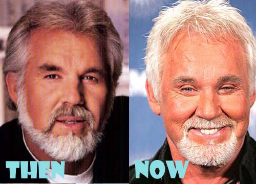 Kenny Rogers Plastic Surgery Before and After Photos