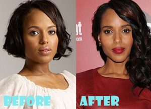 Kerry Washington Plastic Surgery