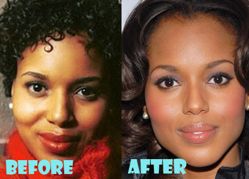 Kerry Washington Plastic Surgery Before and After Photos