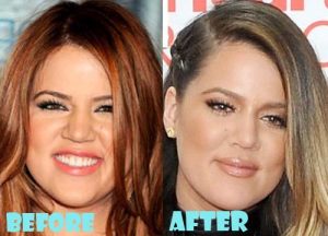 Khloe Kardashian Plastic Surgery