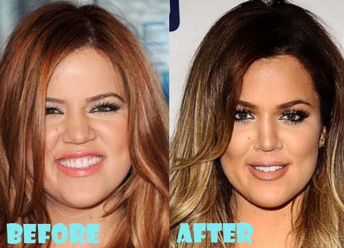 Khloe Kardashian Plastic Surgery Before and After Nose Job