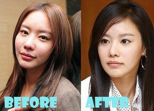 Kim Ah Joong Plastic Surgery Nose Job