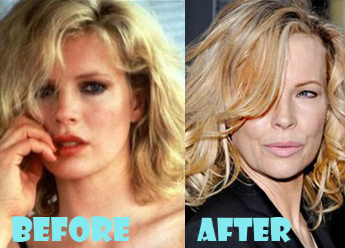 Kim Basinger Plastic Surgery Before and After Pictures