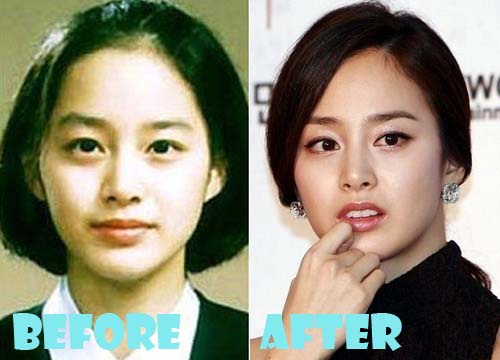 Kim Tae Hee Plastic Surgery