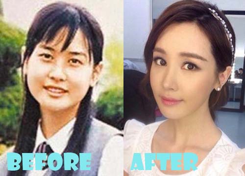Lee Da Hae Plastic Surgery Nose Job Before and After.