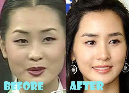 Lee Da Hae Plastic Surgery Before and After Pictures