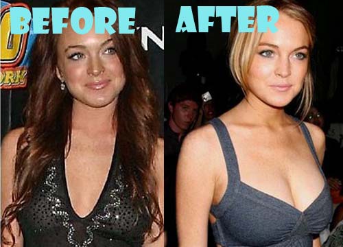 Lindsay Lohan Plastic Surgery Breast Implant Before and After.