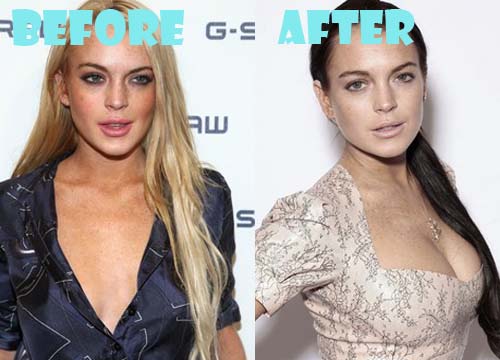 Lindsay Lohan Plastic Surgery Before and After Pictures