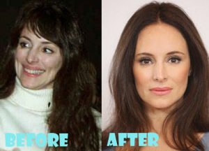 Madeleine Stowe Plastic Surgery