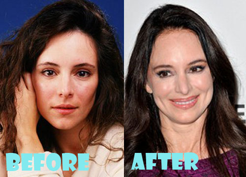 Madeleine Stowe Plastic Surgery Lip Augmentation