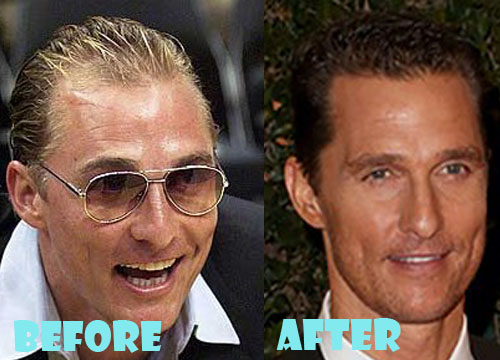 Matthew Mcconaughey Plastic Surgery Before and After Picture
