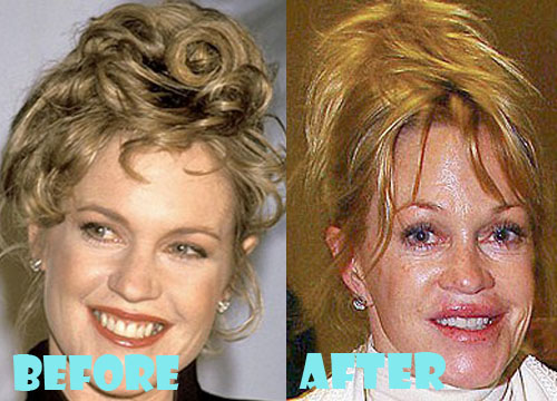 Melanie Griffith Plastic Surgery Before and After Photos
