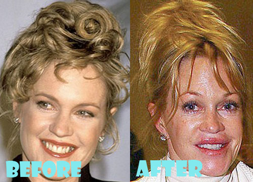 Melanie Griffith Bad Plastic Surgery