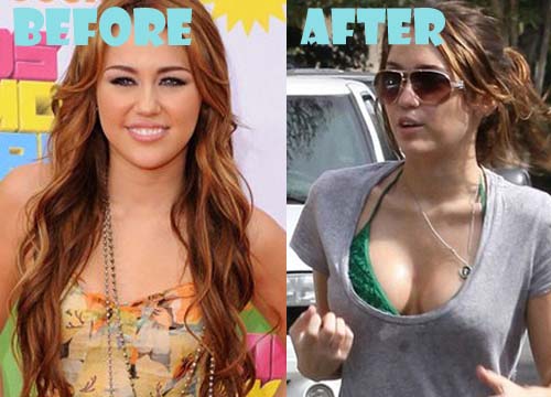 Miley Cyrus Plastic Surgery Before and After Breast Implant