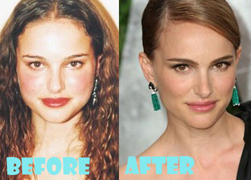 Natalie Portman Plastic Surgery Before and After Nose Job