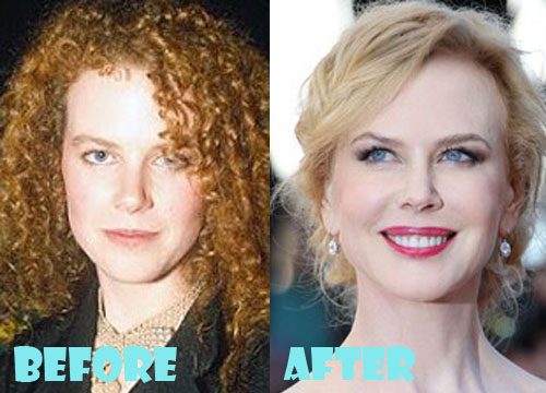 Nicole Kidman Plastic Surgery Before and After Photos