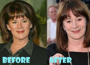 Patricia Richardson Plastic Surgery Botox, Dermal Filler