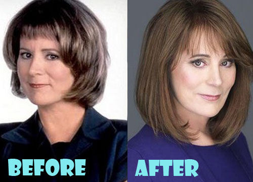 Patricia Richardson Plastic Surgery