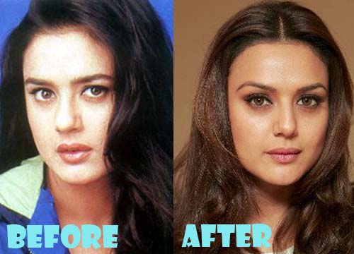 Preity Zinta Plastic Surgery Before and After Photos