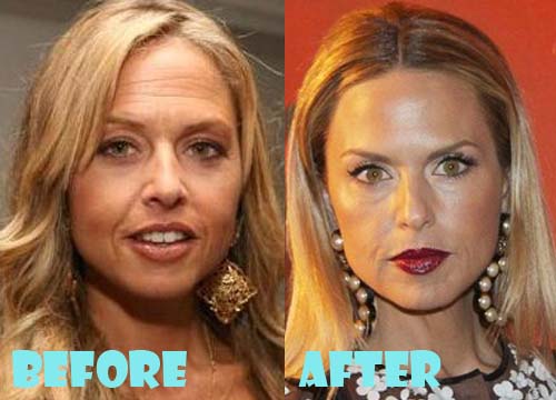 Rachel Zoe Plastic Surgery Before and After Photo