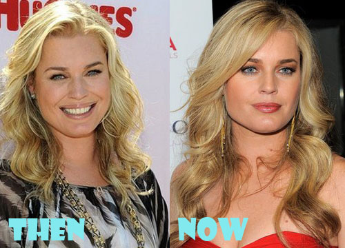 Rebecca Romijn Plastic Surgery Before and After Picture