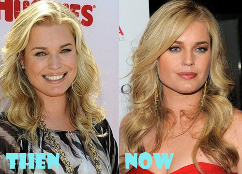 Rebecca Romijn Plastic Surgery