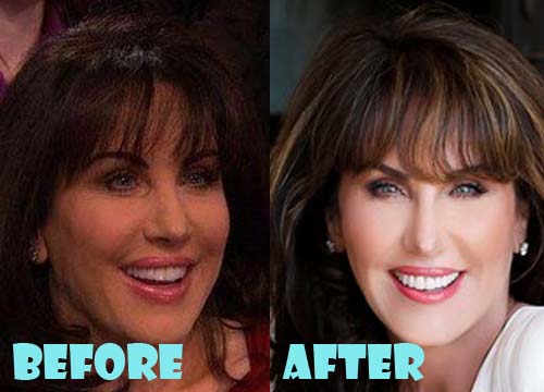 Robin McGraw Plastic Surgery Before and After Picture