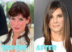 Sandra Bullock Plastic Surgery