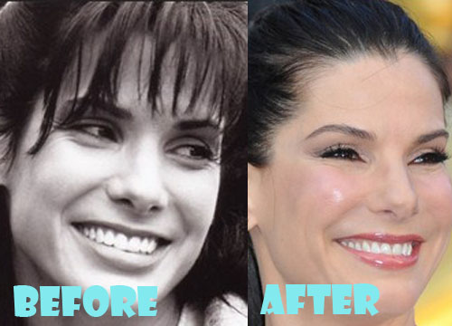 Sandra Bullock Plastic Surgery Before and After Pictures