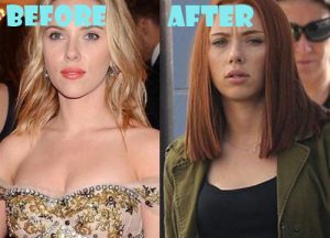 Scarlett Johansson Plastic Surgery