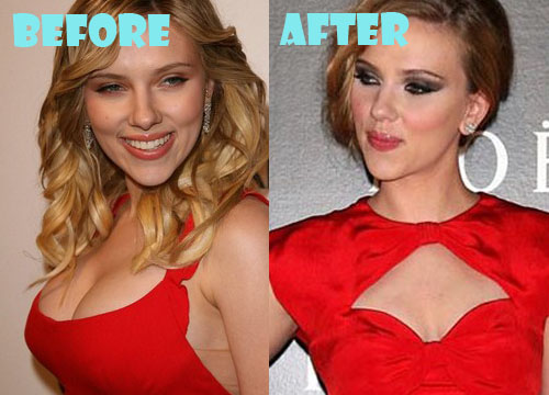 Scarlett Johansson Plastic Surgery Boob Job.