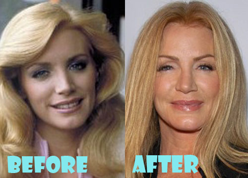 Shannon Tweed Plastic Surgery Before and After Pictures