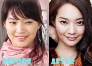 Shin Min Ah Plastic Surgery Nose Job