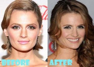 Stana Katic Plastic Surgery