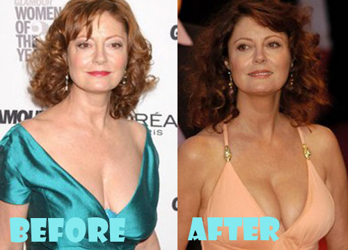 Susan Sarandon Plastic Surgery Boob Job