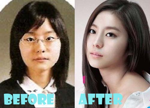 Uee Plastic Surgery Before and After Eyelid Surgery