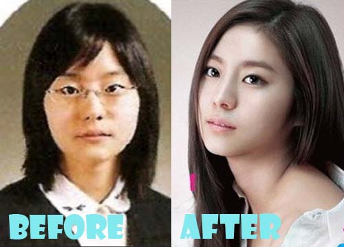 Uee Plastic Surgery Blepharoplasty