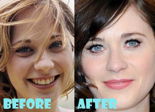 Zooey Deschanel Plastic Surgery Nose Job