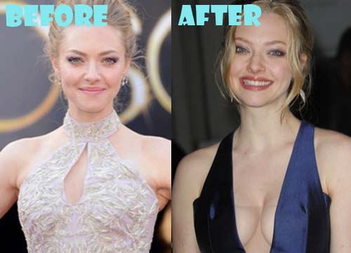 Amanda Seyfried Plastic Surgery Breast Implants