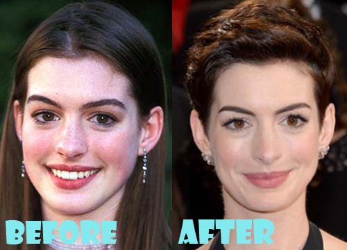 Anne Hathaway Plastic Surgery