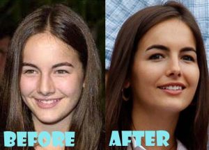 Camilla Belle Plastic Surgery