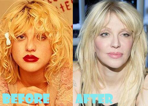 Courtney Love Plastic Surgery Chin Implant