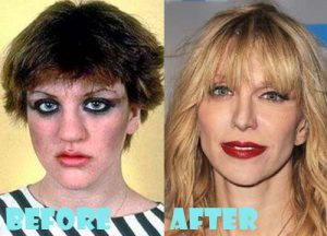 Courtney Love Plastic Surgery Nose Job