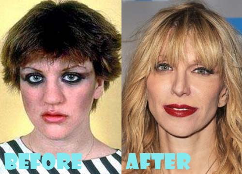 Courtney Love Plastic Surgery Nose Job Before and After.