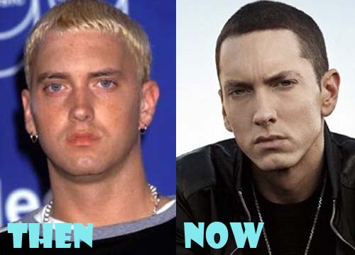 Eminem Plastic Surgery Botox