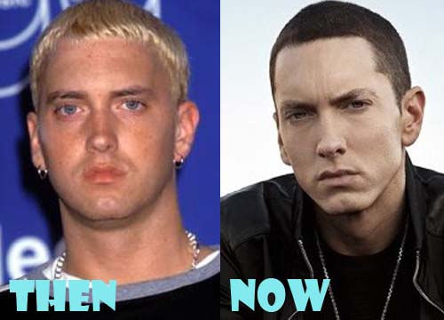 Eminem Plastic Surgery Before and After Botox