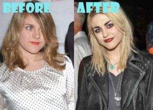 Frances Bean Cobain Plastic Surgery