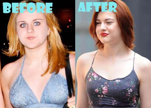 Frances Bean Cobain Plastic Surgery Breast Implant