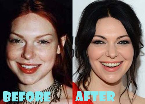 Laura Prepon Plastic Surgery Nose Job