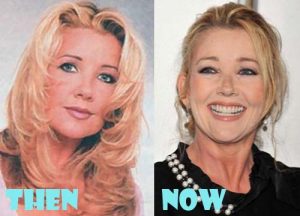 Melody Thomas Scott Plastic Surgery